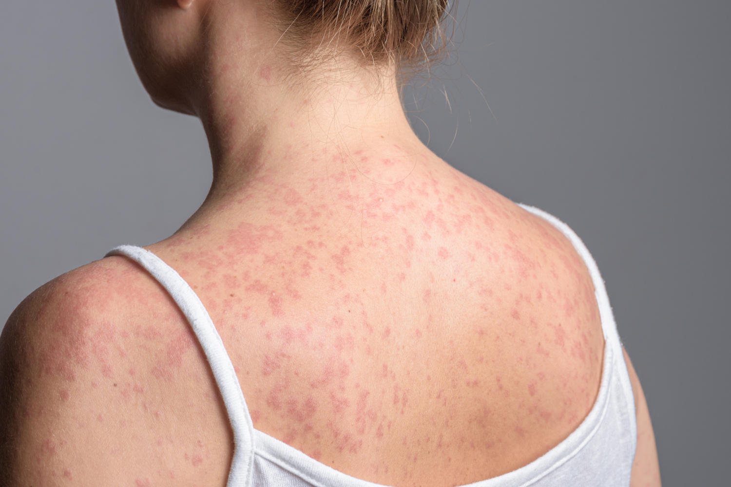Adult-Measles-1500x_1798882712.jpg